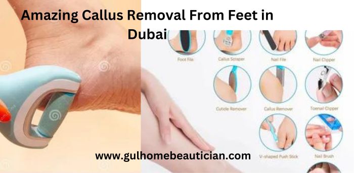 Amazing Callus Removal From Feet in Dubai